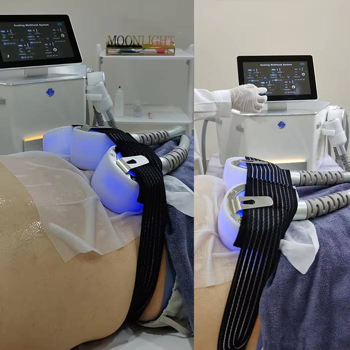 membrane anticongelamento per cryolipolisi